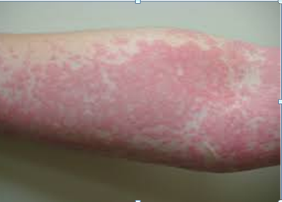 Steroid injection causing rash